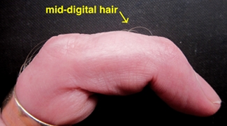 finger with mid-digital hair